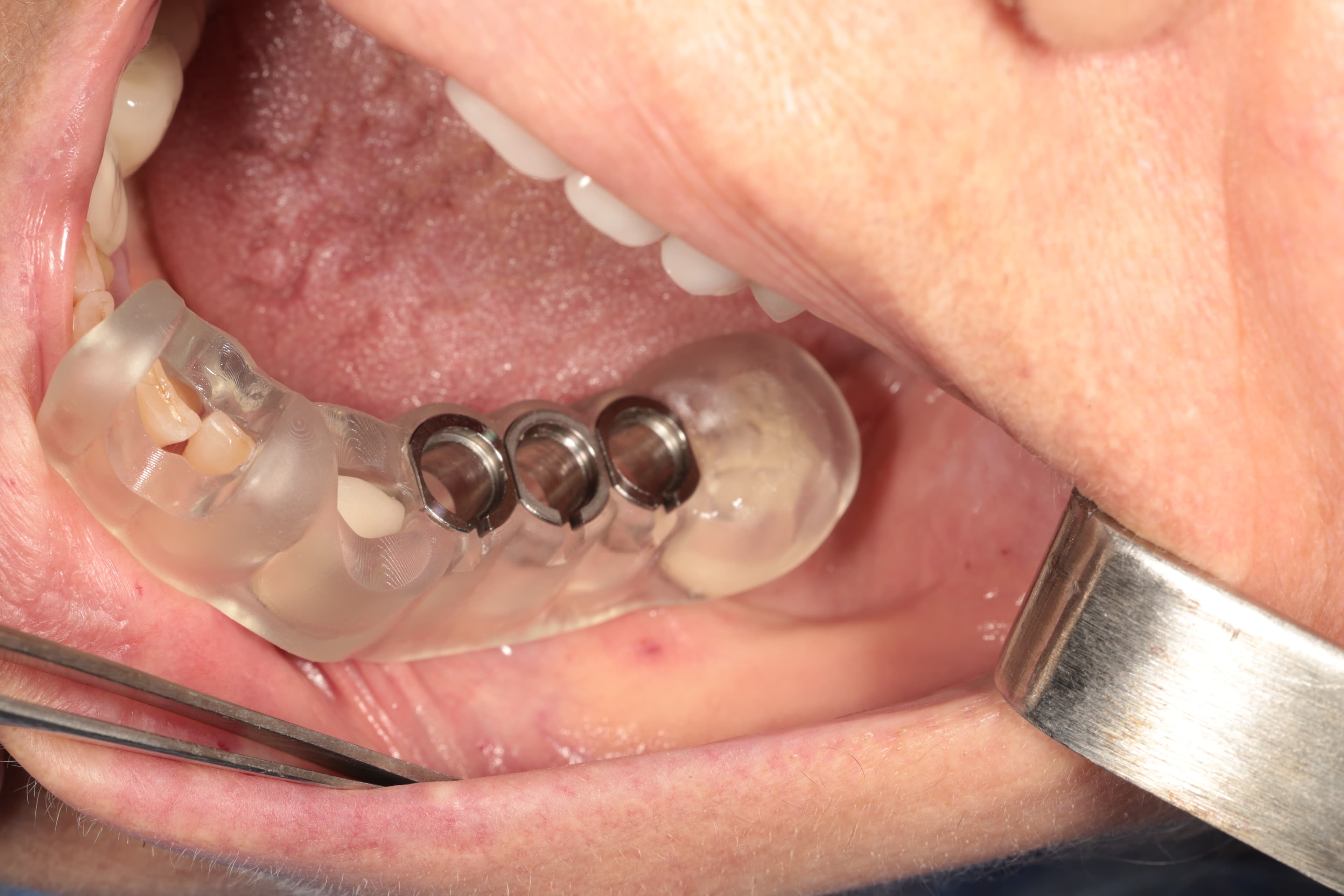 Dikişsiz İmplant Tedavisi: Flapsız Cerrahi ile Hızlı İyileşme