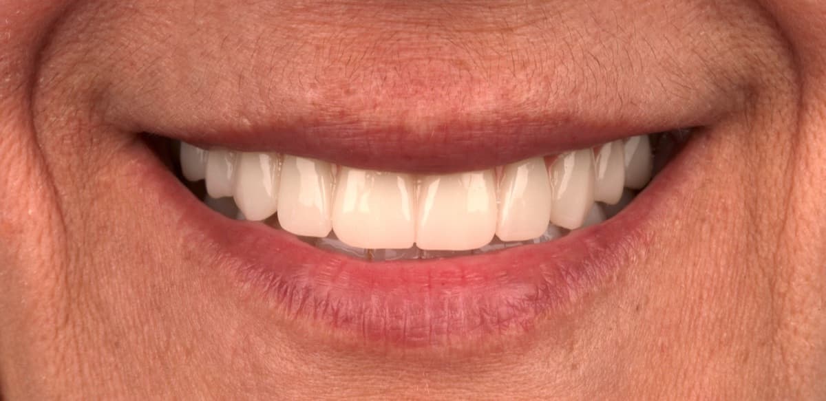 Diş kaplama çeşitleri ve fiyatları karşılaştırması