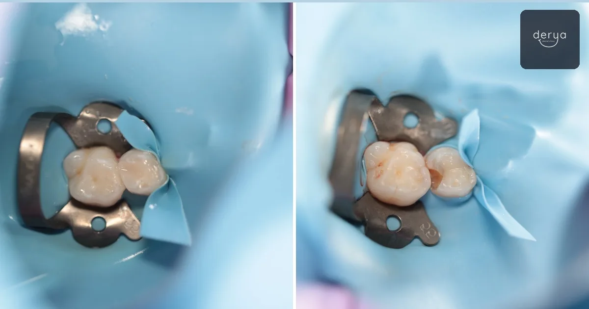 Stages of tooth decay and treatment options