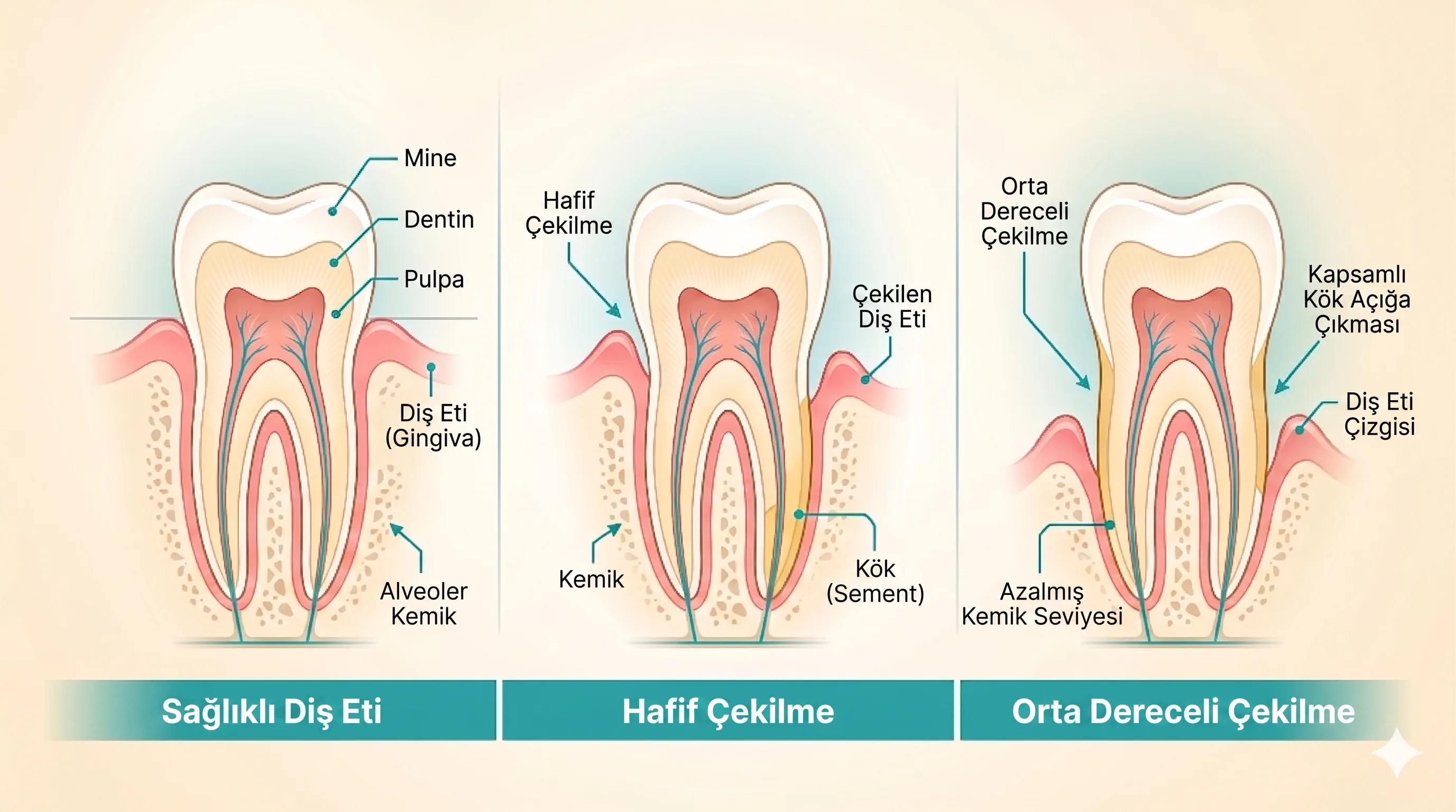 Gum recession treatment and causes