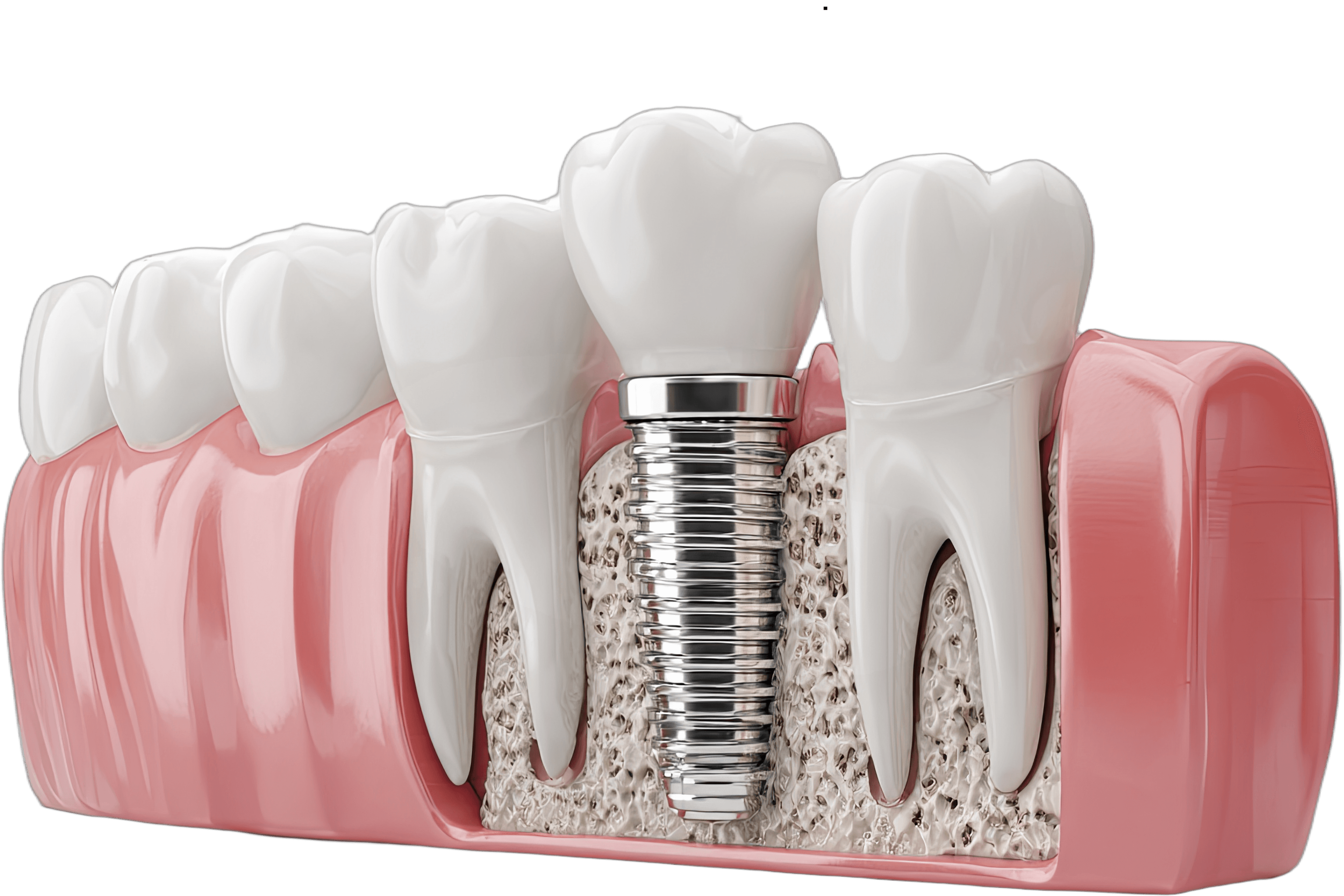Diş implantı çene kemiği kesit görünümü - titanyum vida ve porselen kron yapısı