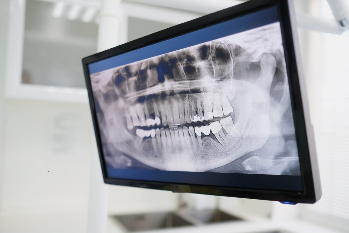 Panoramic X-ray digital imaging screen - Maltepe Derya Dental Clinic