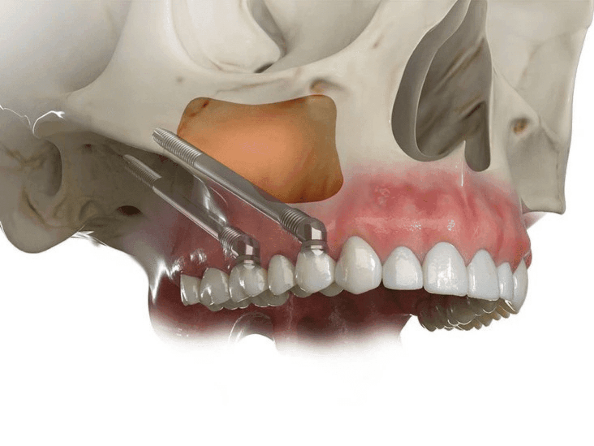 Zygomatic and subperiosteal implant treatment - advanced implantology