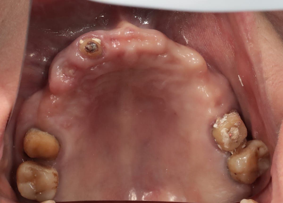 Vaka 1 tedavi öncesi ağız içi görüntü