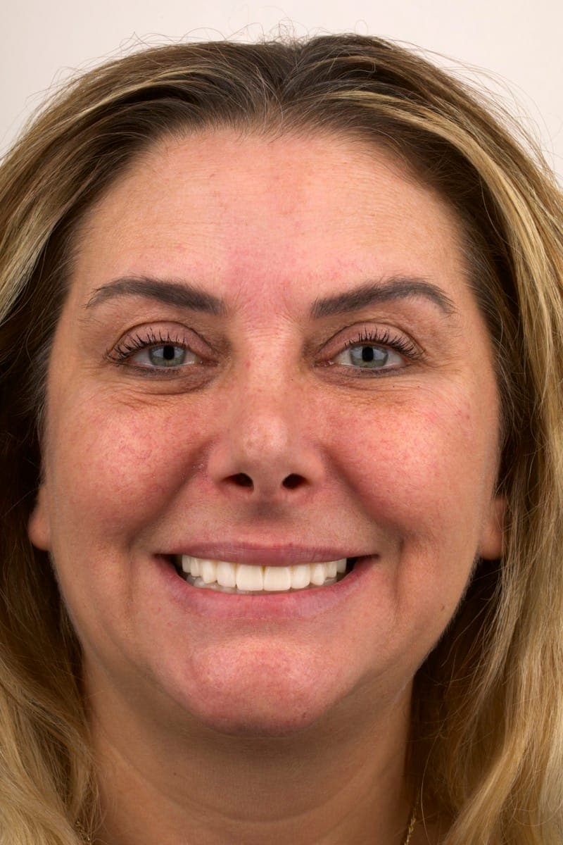 Vaka 1 tedavi sonrası implant üstü protez