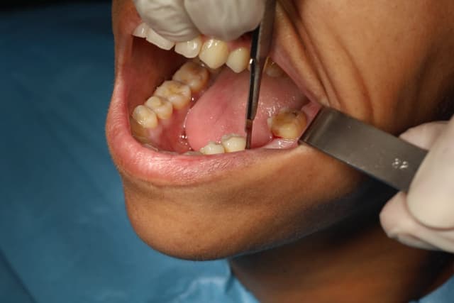 Implant surgical procedure — Derya Dental Clinic