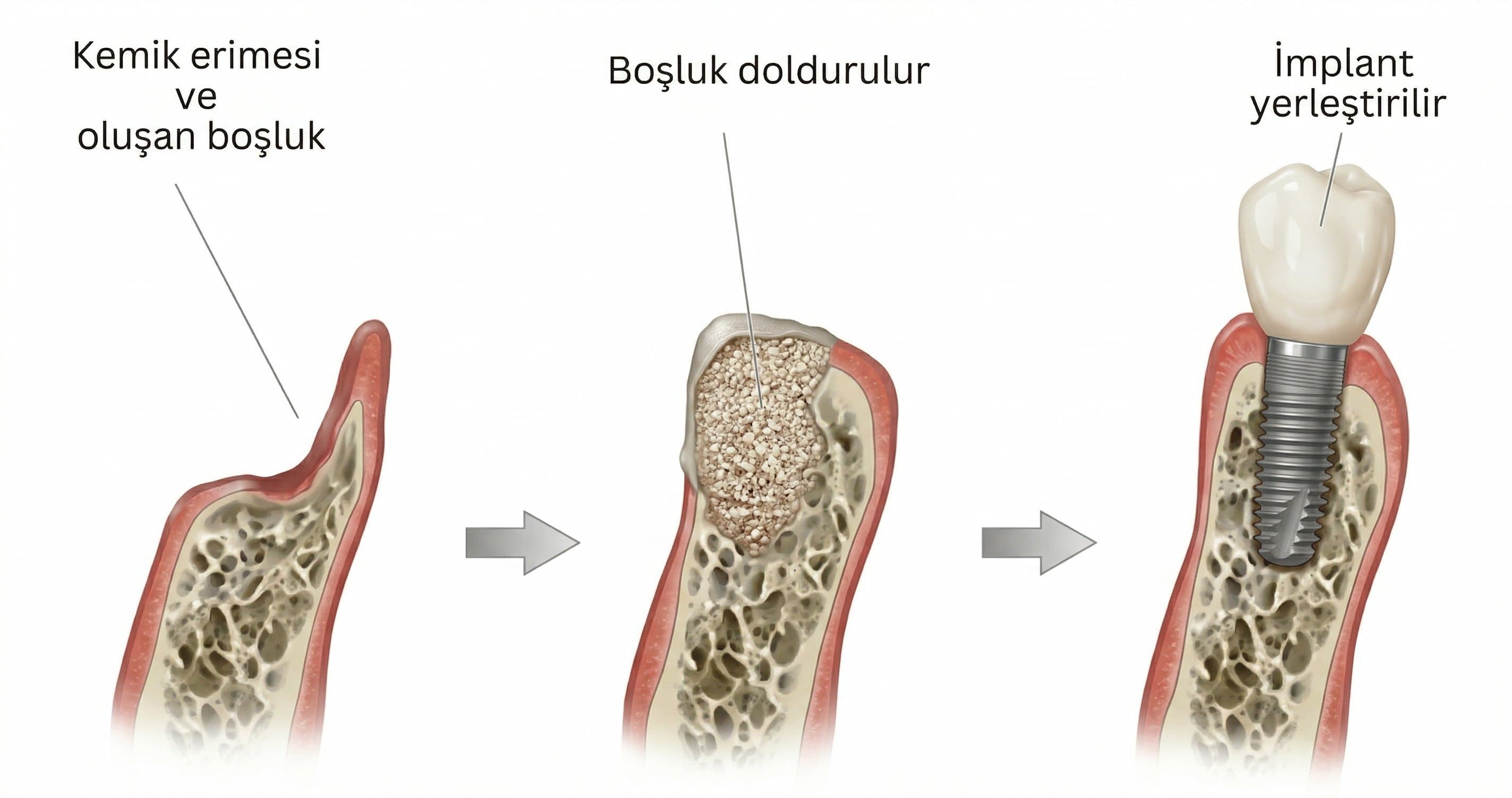 Atrofik Çenede İmplant Karar Rehberi: Greftleme, Uzak Ankraj ve Subperiostal — Hangi Çözüm Kime?