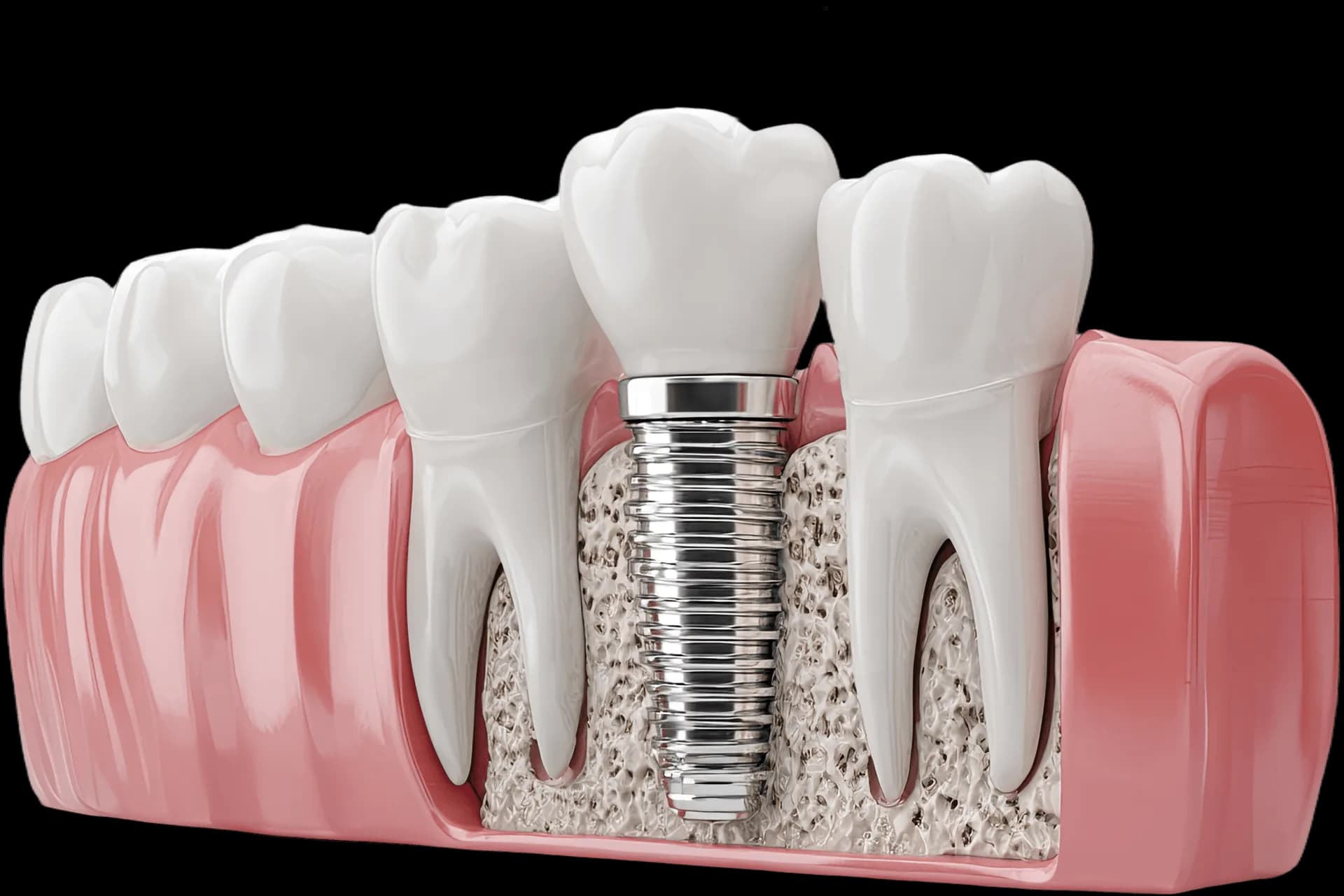 Diş implantı çene kemiği kesit görünümü - titanyum vida ve porselen kron yapısı