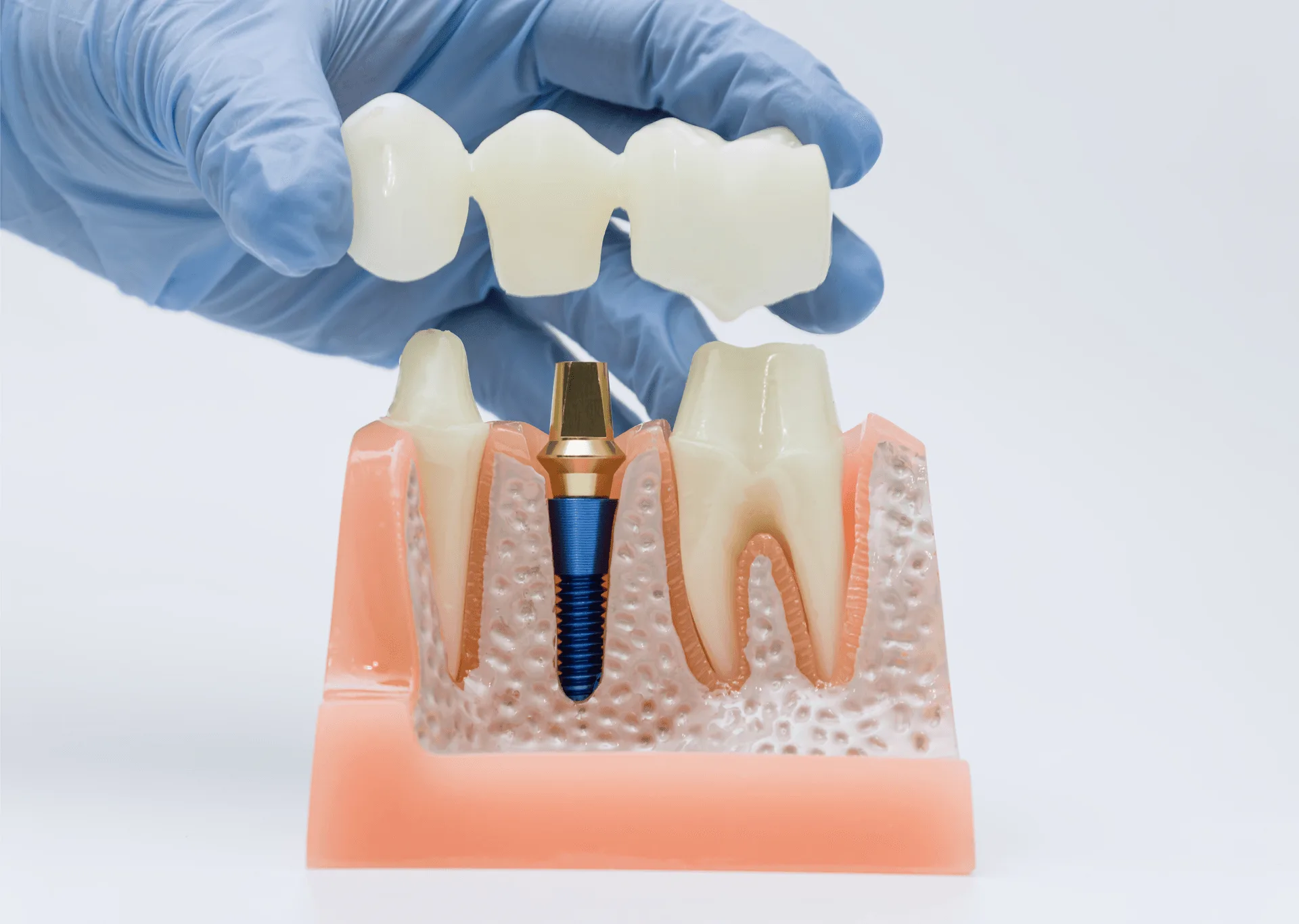 Diş implantı üzerine köprü protez uygulaması - implant tedavi modeli