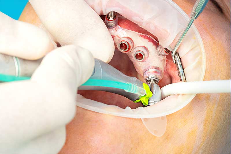 Derya Diş Kliniği'nde dijital implant cerrahisi planlama - Maltepe Fındıklı