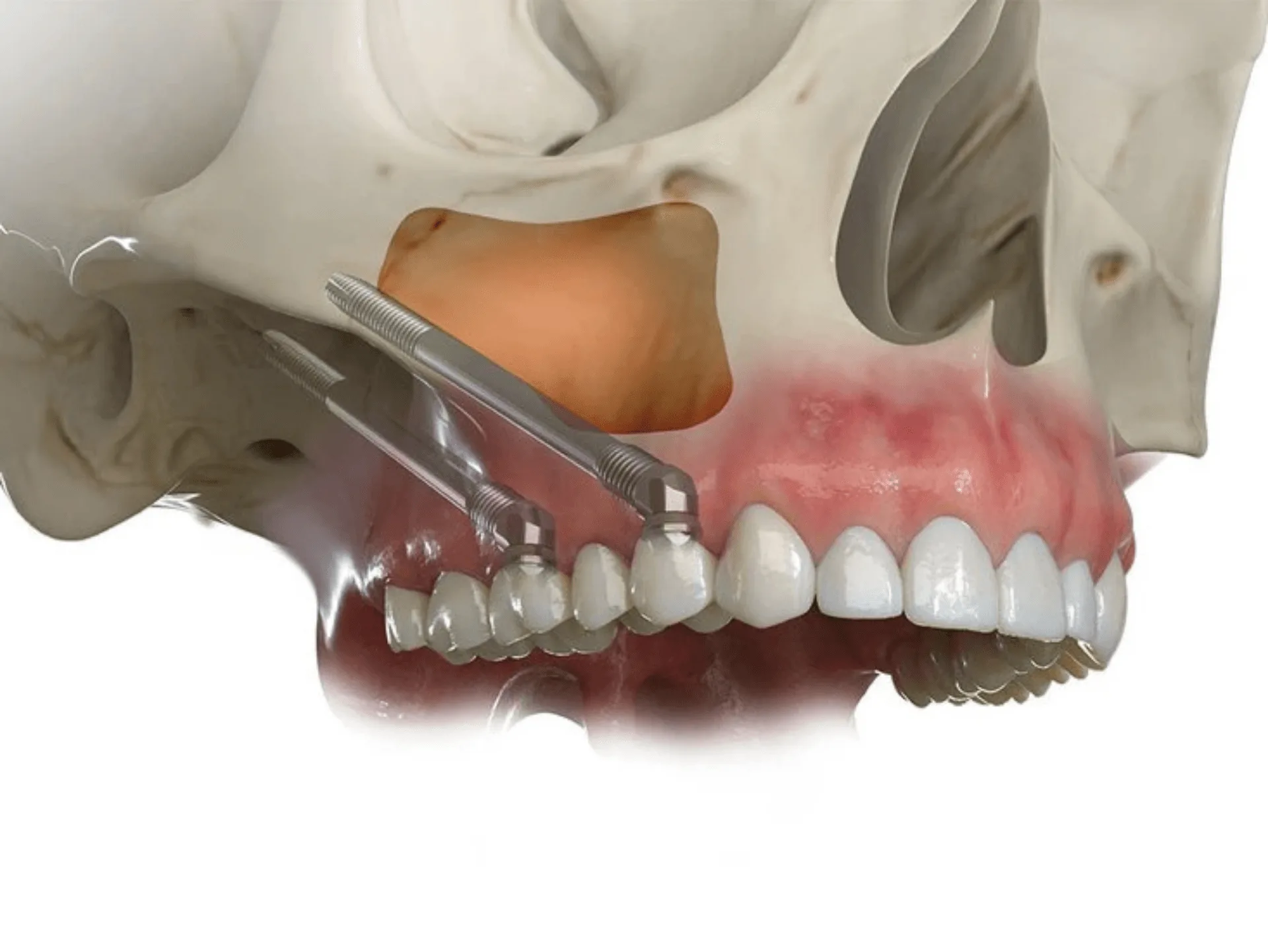 Zygomatic and Subperiosteal Implants: Advanced Solutions for Bone Deficiency