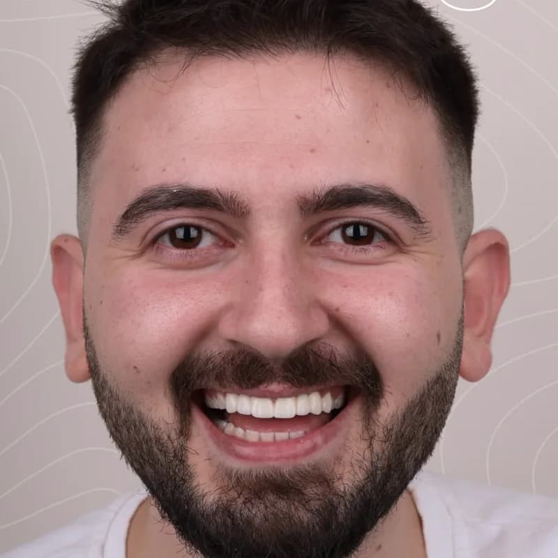 Doğuştan diş eksikliği ve diastema vakası — gülüş estetiği zirkonyum çözümü