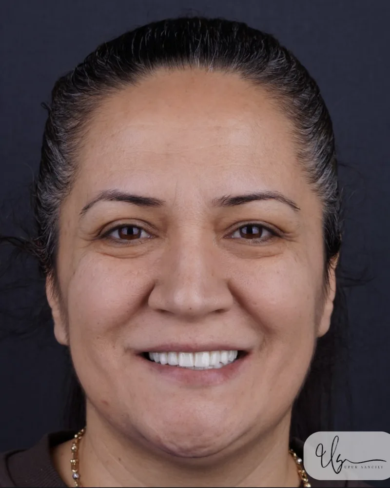 Agresif periodontitis tedavisi — alt ve üst çene tam diş protezi sonrası gülümseme
